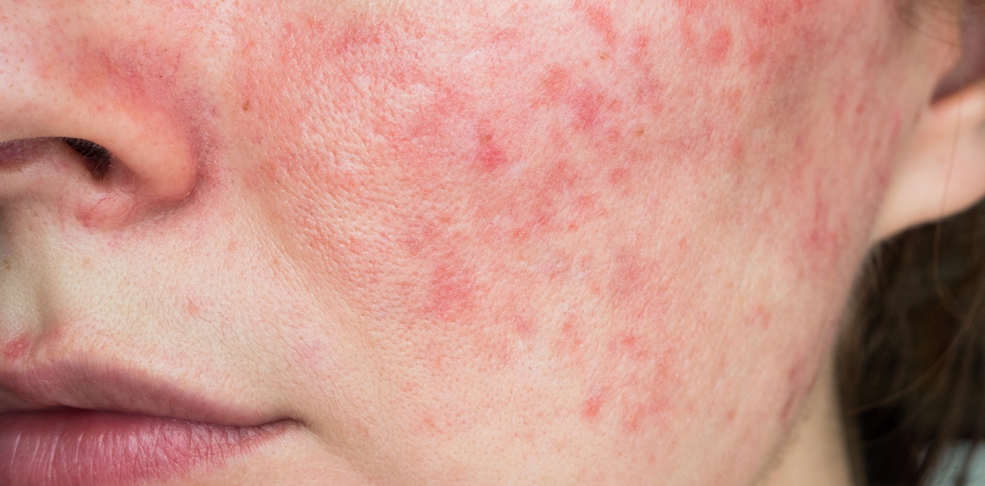 Dermatologo per cura dell’acne a Rende